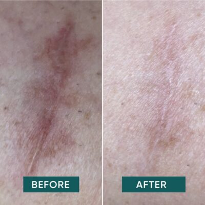 APRICOT pad cicatrice réutil scar scar away 4 pce
