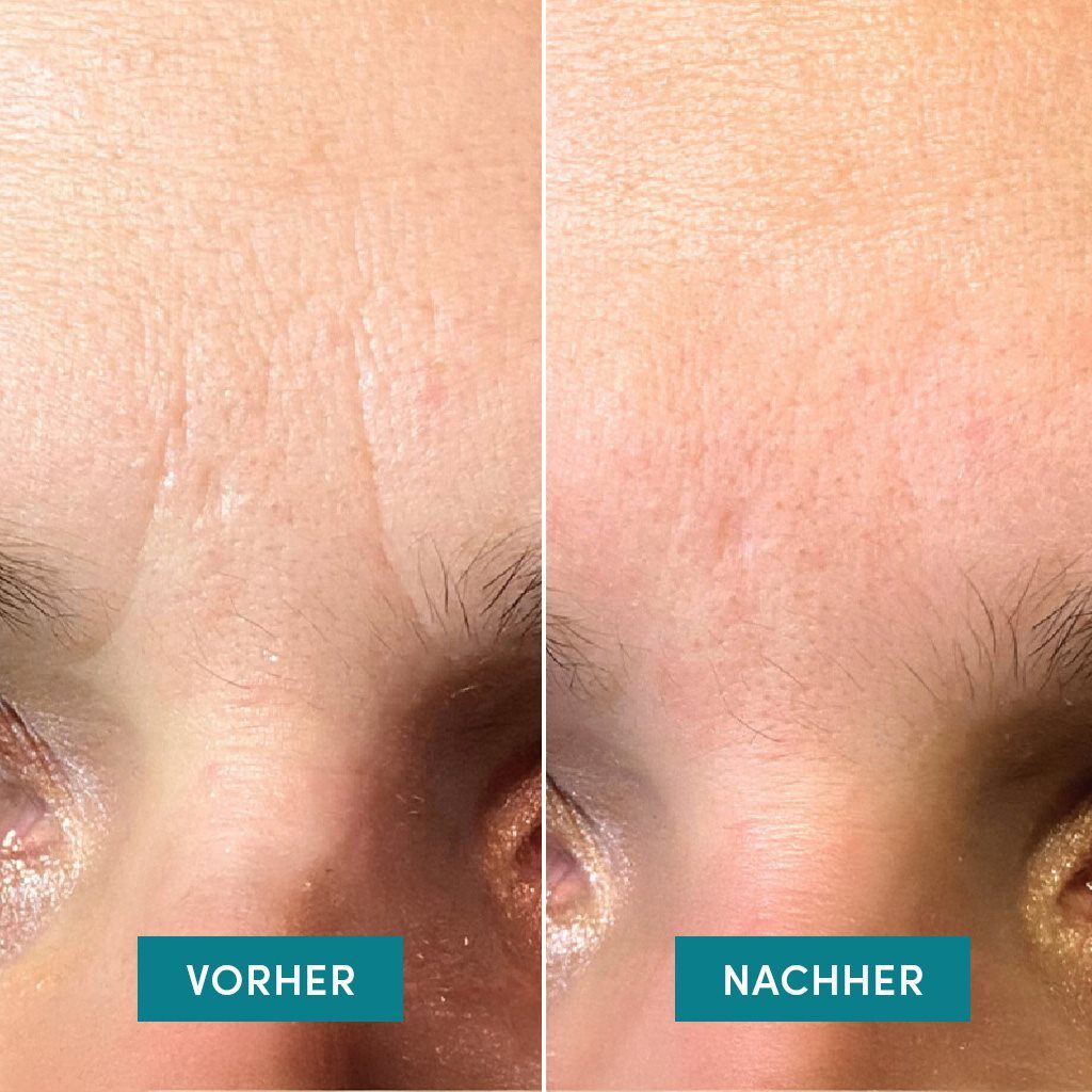 APRICOT patchs visage ect face charmer 100 pce