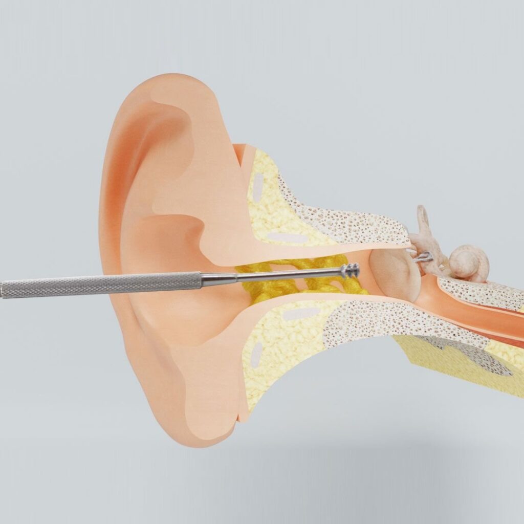 REUSEME outil de nettoyage d'oreille
